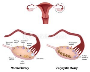 FINALLY - HELP FOR PCOS SUFFERERS? 7